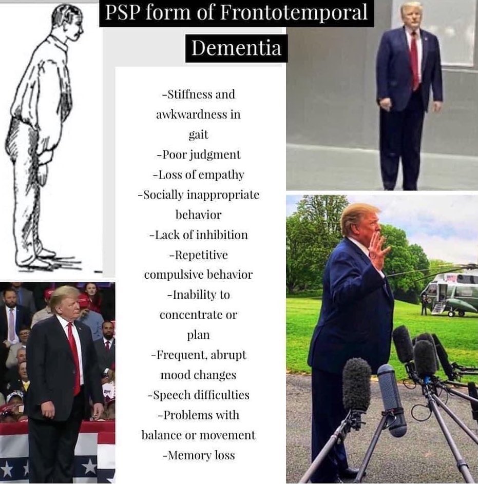 Nikkithegreen's tweet photo. @Ifonlyme7 @Anna_Sf_Ly @candyresists @AnnieForTruth @waitnwallflower @Here4LeftyNews @firefly909 @beachlifelinda1 @Meghanduggan1 @Sharibearpaws1 @4HumanUnity @LauraLeeAZ21 @loveshine204 @pm_mcdaniel @burnsmchumprson He in almost certain suffering from frontolobal dementia #DementiaDon https://t.co/w2qlUlwigo