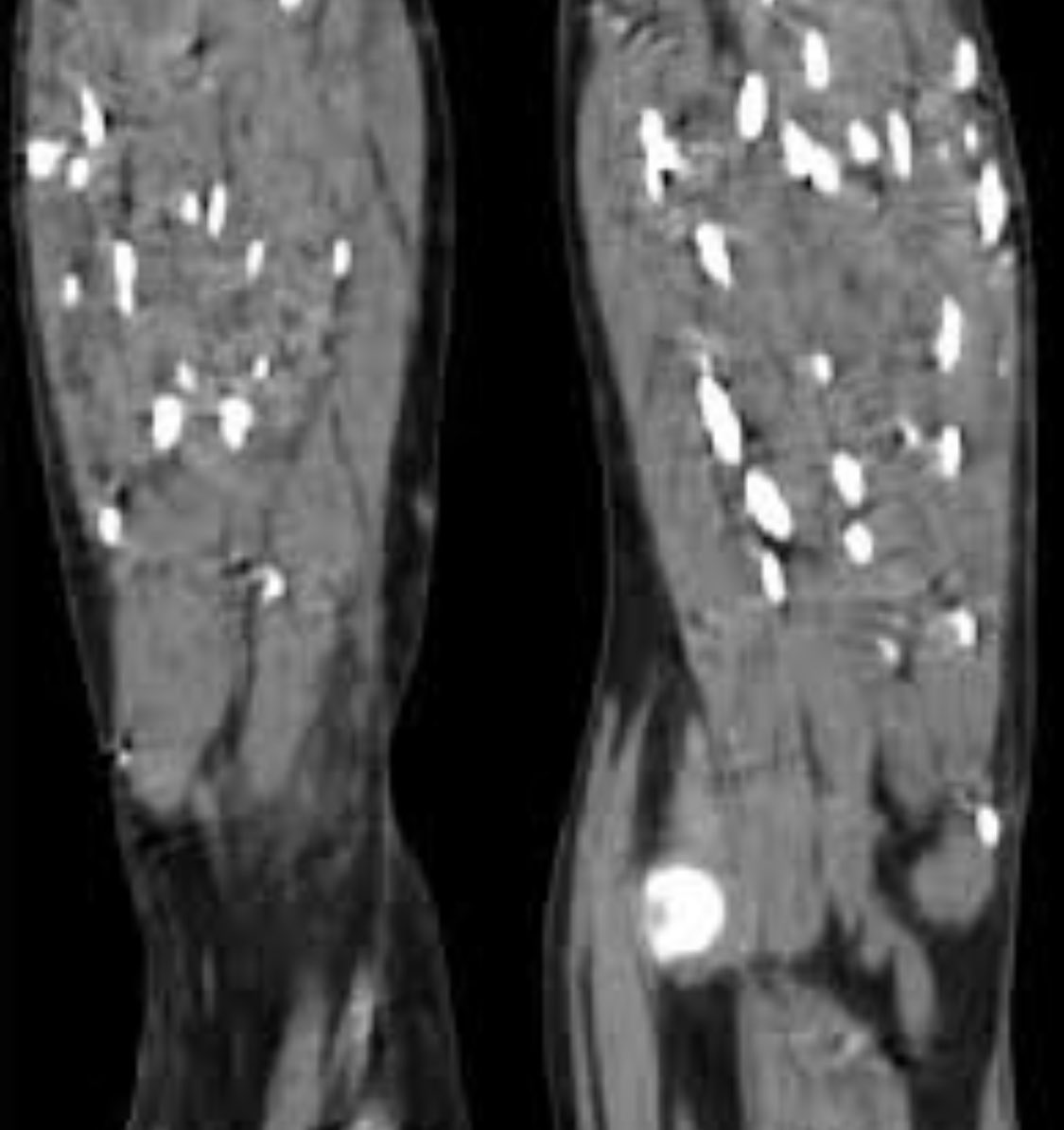 Man with confusion and weight loss. What are these? (Via Radiographics) #raded #meded #radiology #radres #medical #usmle #medtwitter #radtwitter #IDtwitter