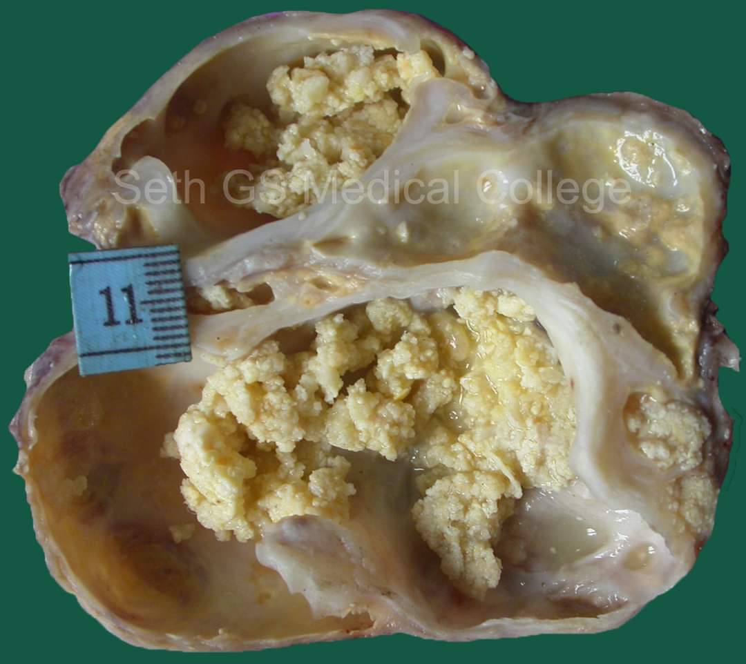 #COTW - 22 years Female; Presentation as dyspnea on exertion; Mass over the basal aspect of the heart