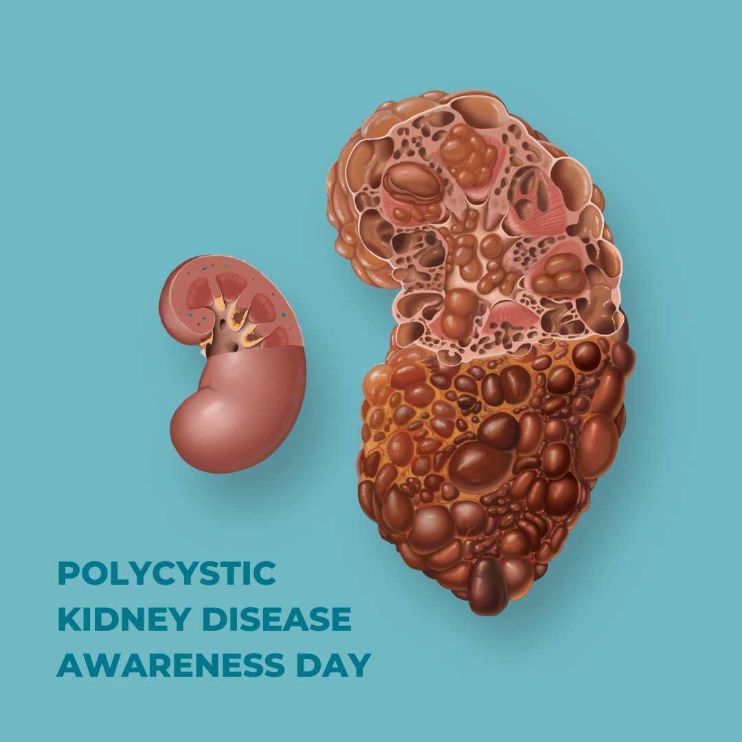 PKDFoundation's tweet photo. #PKDAwarenessDay Polycystic kidney disease (PKD) is a chronic, genetic disease causing the uncontrolled growth of cysts in the kidney, eventually leading to kidney failure. https://t.co/fSsQNu5pyT