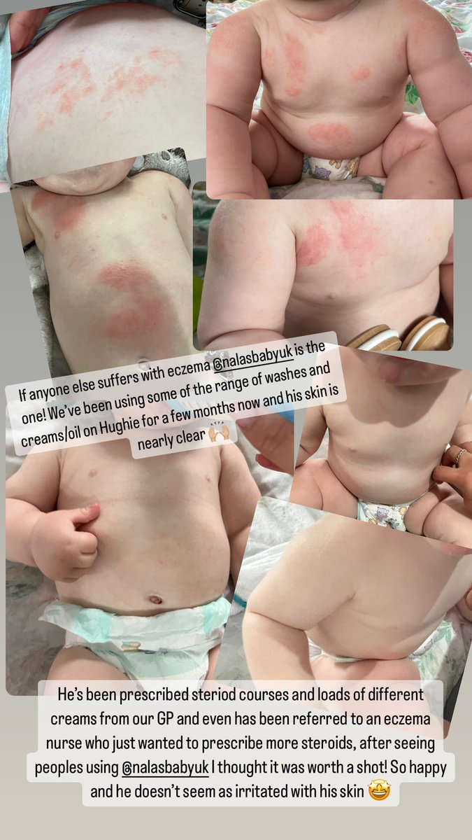 GeorginaAllenxo's tweet photo. @iain1872 Nalas baby has cleared my little ones eczema up https://t.co/i0G2PA1EgH