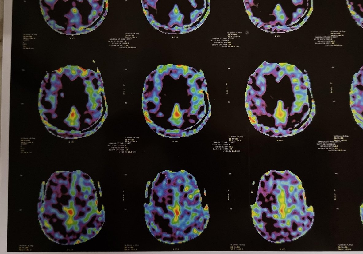 #neurotwitter, #neuroquiz
A patient with Dementia shows this MRI on the ASL( Arterial spin labelling) sequence