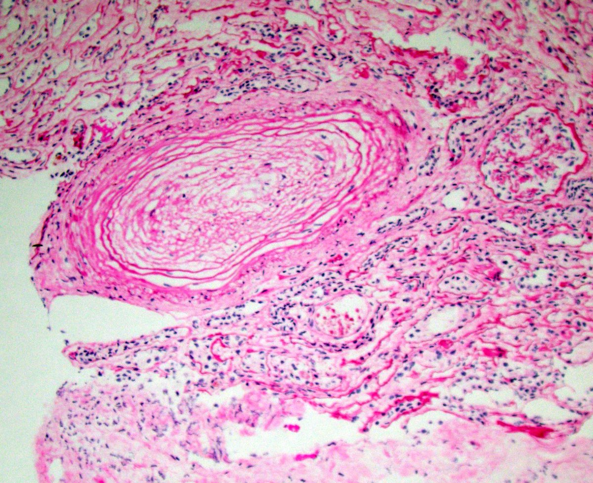 Biopsy for AKI in a pt with systemic sclerosis. Severe active and chronic TMA with marked concentric fibrointimal sclerosis (onion skin change) with entrapped schistocytes. Ischemic 'bloodless' glomeruli. Overall clinically c/w scleroderma renal crisis. #renalpath #pathtwitter