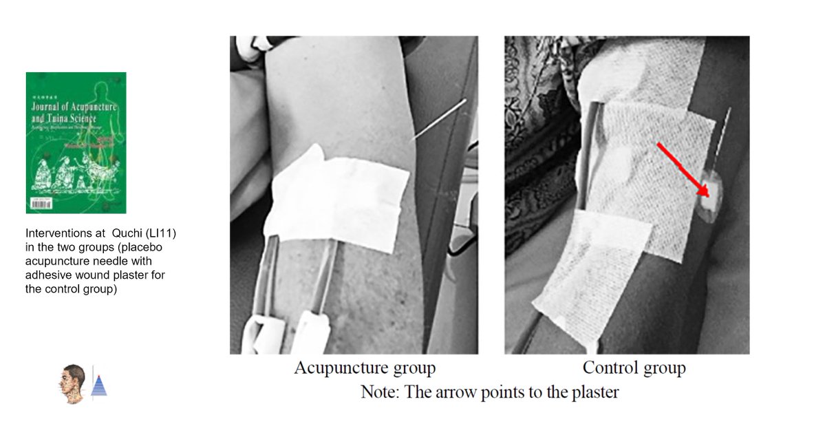 🔀Randomized controlled trial 🇮🇩
📰J Acupunct Tuina Sci
Uremic pruritus. Effectiveness of acupuncture [A] 𝑣𝑠 sham [A]. ↘ pruritus [5-D Itch-Scale] ↘ serum interleukin-2 [IL-2] level.

doi.org/10.1007/s11726… 🔓
#acupuncture