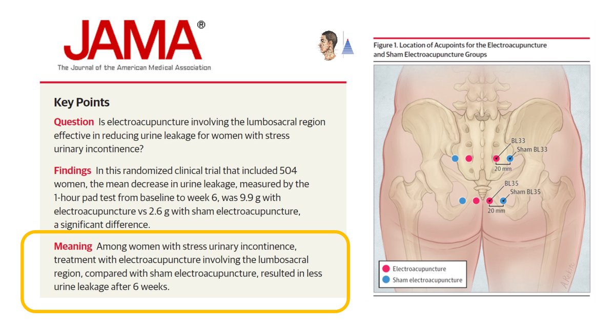 🔀Multicenter randomized controlled trial 🇨🇳
📰JAMA (IF 𝟰𝟱.𝟱)
Stress urinary incontinence. Effectiveness of acupuncture 𝑣𝑒𝑟𝑠𝑢𝑠 sham acupuncture. ↘ 1-hour pad test, ↘ frequency of episodes over 72 hours, ↗ quality of life.

pubmed.ncbi.nlm.nih.gov/28655016/ 🔓