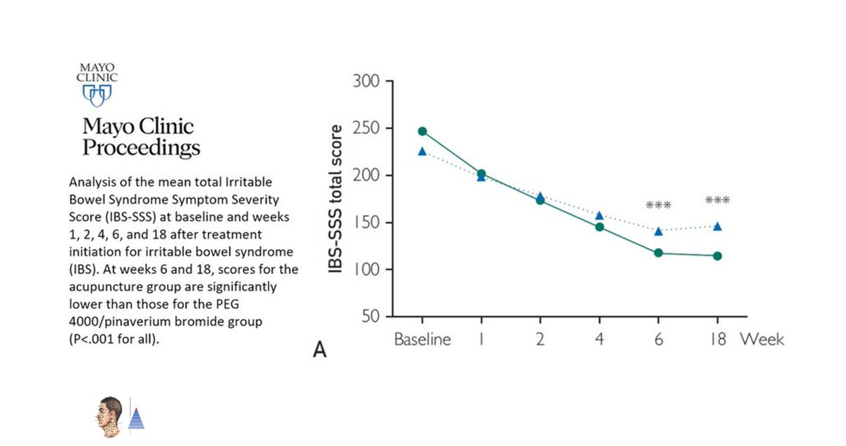 🔀Multicenter pragmatic randomized controlled trial 🇨🇳
📰Mayo Clin Proc (IF 𝟲.𝟵)
Irritable bowel syndrome. Effectiveness of acupuncture 𝑣𝑒𝑟𝑠𝑢𝑠 pinaverium bromide (150 mg/d) 𝑜𝑟 polyethylene glycol 4000 (20 g/d). ↘ IBS-symptom severity score.

pubmed.ncbi.nlm.nih.gov/32499125/🔓