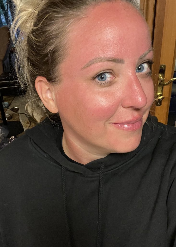 Steph__Paige's tweet photo. Just a tiny bit crispy from drinking on a float or in the lake for five hours yesterday ๐น #cottageproblems https://t.co/ja8iyuDUTE