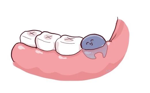 #い・らくすと抜かないといけないタイプの親知^ら^ず 