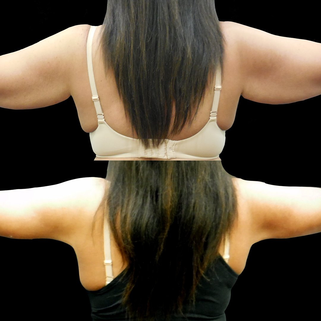 GeminiPlastics's tweet photo. #Brachioplasty, #ArmLiposuction #5087
-
47yo, F
Issue: Patient complained about excess skin on her arms after significant weight loss. After losing all the weight, she wants to improve the appearance of her arms.
Remedy: Brachioplasty, Arm Liposuction
Post-Op: 3 mo https://t.co/Jv2F5PZIxw