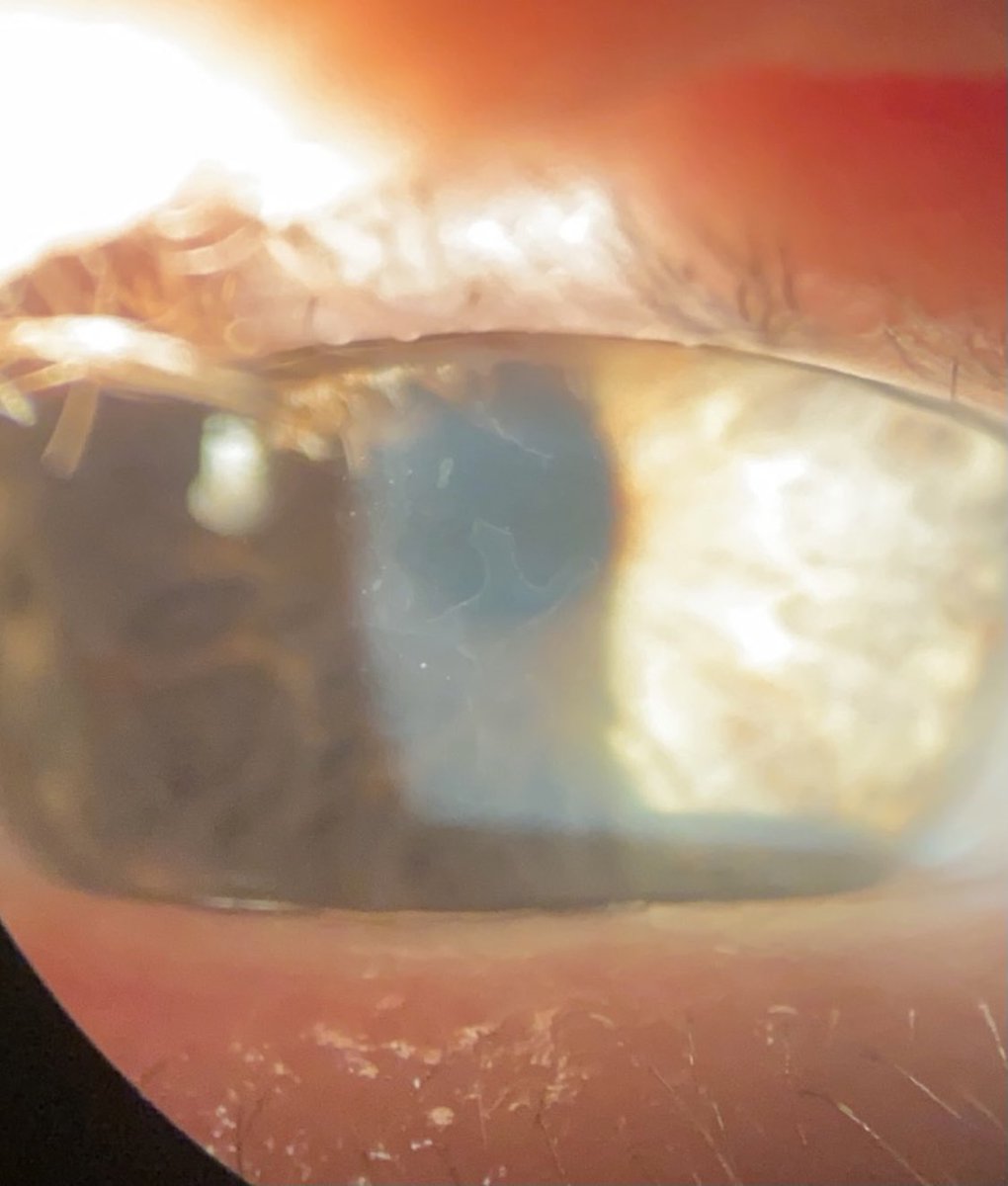 thecorneaMD's tweet photo. Anterior basement membrane dystrophy
- Symptoms: blurry vision and recurrent erosions
- Management
     1.  Lubrication
     2. Bandage contact lens therapy
     3. Superficial keratectomy

#cornea #Ophthalmology #aao #ascrs #cararact https://t.co/6DQrOdD1AV