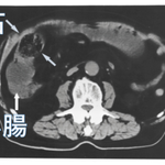 「空腹時に柿だけ大量に食す」のは注意!体質により「柿胃症」を引き起こすかも？？