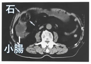 「空腹時に柿だけ大量に食す」のは注意！！体質により「柿胃症」を引き起こすかも？？