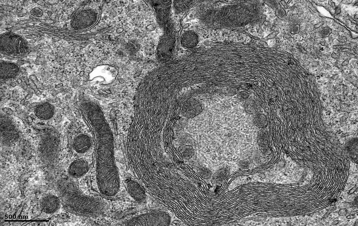 JohnBrealey's tweet photo. Native kidney bx. EM shows interesting structures in a few distal tubular cells. Membranes appear to be encircling mitochondria. The resultant structures (? autophagosomes) have a double membrane and are packed with filaments. Is this mitophagy in action? #mitophagy #autophagy https://t.co/xT2mSH20on