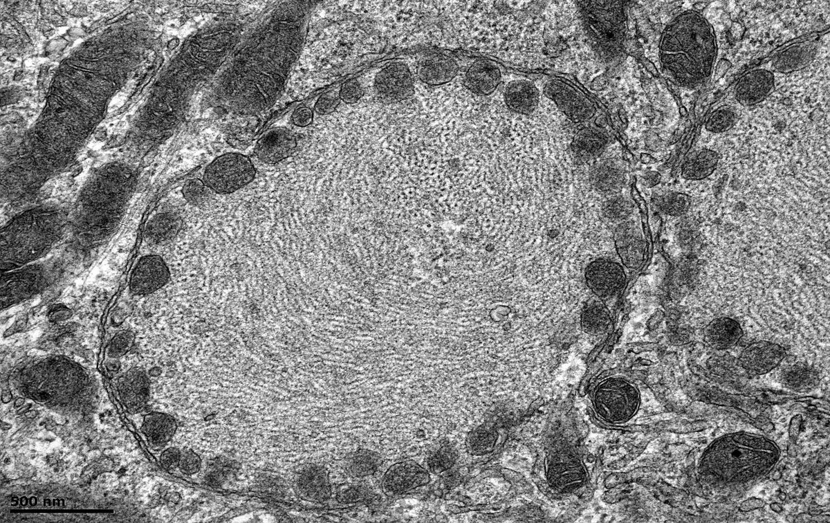 JohnBrealey's tweet photo. Native kidney bx. EM shows interesting structures in a few distal tubular cells. Membranes appear to be encircling mitochondria. The resultant structures (? autophagosomes) have a double membrane and are packed with filaments. Is this mitophagy in action? #mitophagy #autophagy https://t.co/xT2mSH20on