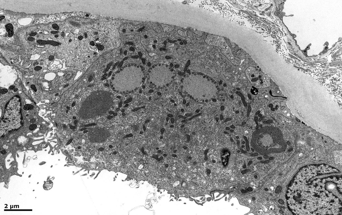 JohnBrealey's tweet photo. Native kidney bx. EM shows interesting structures in a few distal tubular cells. Membranes appear to be encircling mitochondria. The resultant structures (? autophagosomes) have a double membrane and are packed with filaments. Is this mitophagy in action? #mitophagy #autophagy https://t.co/xT2mSH20on