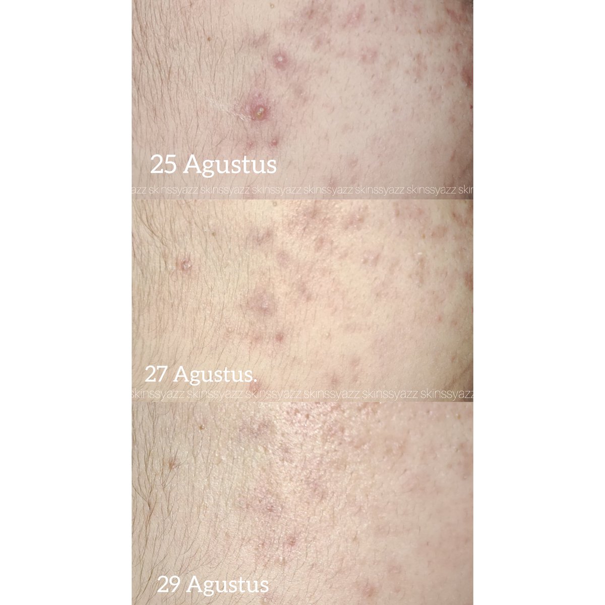 skinssyazz's tweet photo. Aku ada rekomendasi Acne gel yang sangat terjangkau dengan kualitas yang oke!!!
Acneprone skin kayaknya wajib stok obat totol jerawat deh, soalnya kita ngga tau kapan muncul jerawat & harus siap sedia biar jerawat cepat reda & kempes.
#LetsBeeClear #racuninskincare https://t.co/bmVWygBmDZ