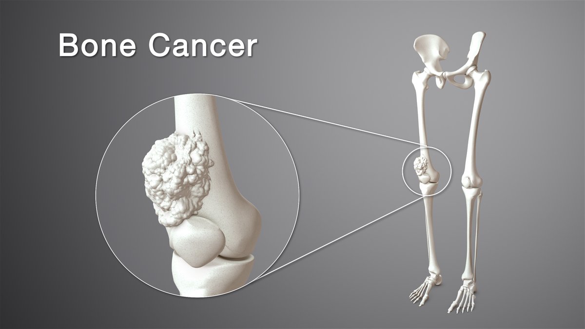 rosaria93111306's tweet photo. Prostate cancer can spread to your legs: the warning sign men should not ignore.
Register Now for Oncology 2022!!
For more information :
📩Email : costarosaria201@gmail.com
URL : https://t.co/sfE09JtEO4
#Amsterdam #Netherlands #DeKoningZegtNee #simonenojn https://t.co/8WnoBUC0wk