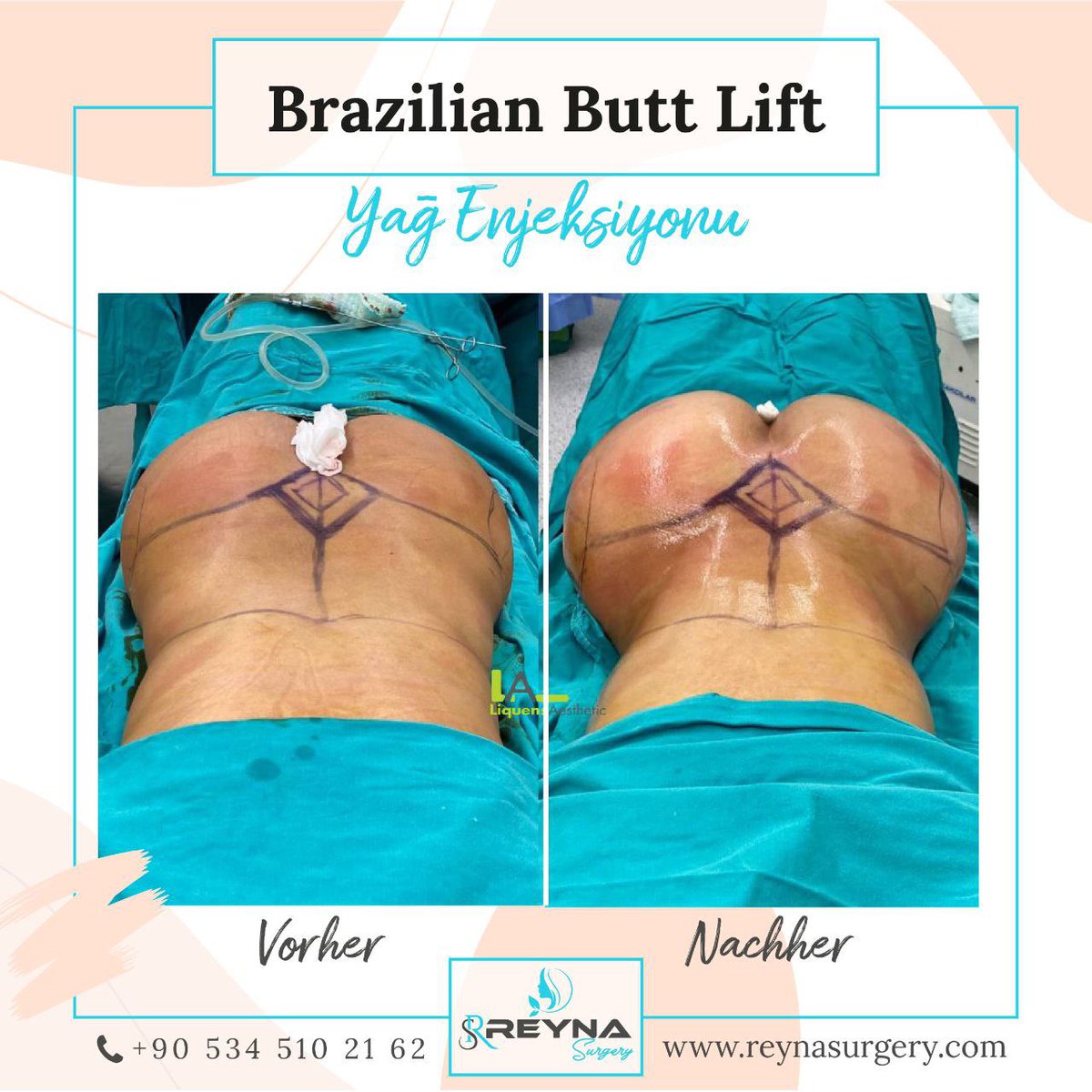 reyna_surgery's tweet photo. Möchtest du auch einen schönen Po haben?
Warum nicht- Sende güzel bir kalçaya mı sahip olmak istiyorsun? 🥰

#bbl #safebbl  #liposuction #vucutsekillendirme #yagenjeksiyonu #yagtransferi #popobuyutme #koln #reynasurgery #köln #TekYuerekKadıkoeydeyiz https://t.co/cnWGezHyF0