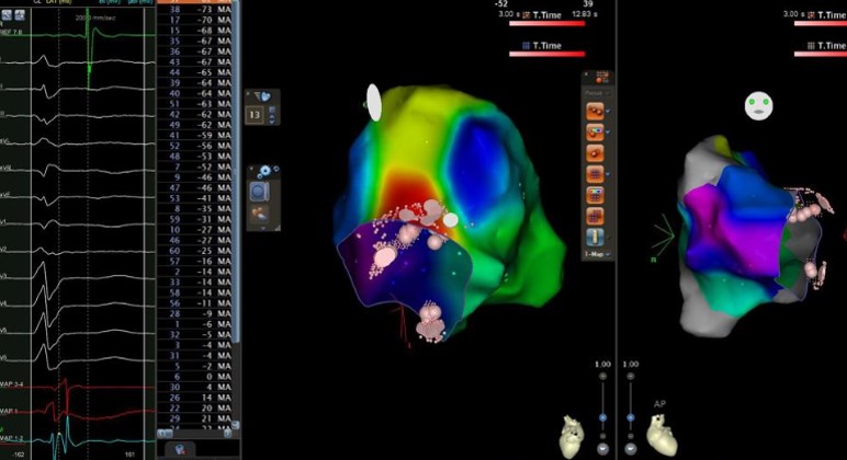 After the first fused complex within TZ, there is abrupt termination of SVT, from <a href="/BarisakdemirEp/">Barış Akdemir</a>

<a href="/SoufianAlMaha/">Soufian AlMahameed MD</a> <a href="/DrGregMichaud/">Gregory Michaud</a> <a href="/Mkara_EP/">Mkara</a> <a href="/ElifhandeMD/">Elif Hande Özcan Çetin</a> <a href="/AhmetKorkmaz07A/">Ahmet</a> <a href="/ozcanozeke/">Özcan Özeke</a> <a href="/prof_serkan_cay/">Prof Dr Serkan Cay</a> <a href="/drfiratozcan/">Fırat Özcan</a> <a href="/DursunAras2/">Dursun Aras, Professor</a> <a href="/topaloglu_prof/">Serkan Topaloglu, MD</a> <a href="/GeorgeKleinMD/">George Klein</a>
doi.org/10.1161/CIRCEP…