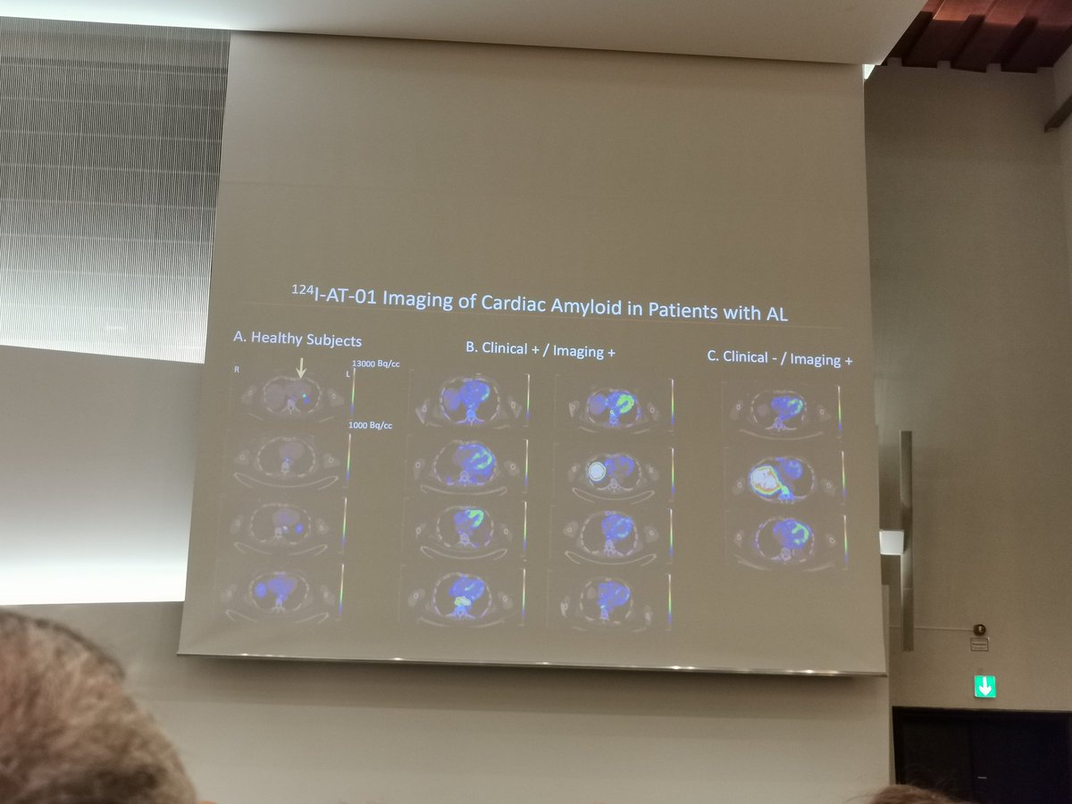 estelais's tweet photo. #ISA_2022 imaging with 124-I-AT-01? yes, it's a reality 🙌 by Jonathan Wall from #TennesseeUniversity @ISA_Amyloidosis 1/2 https://t.co/SYj0s8wKHu