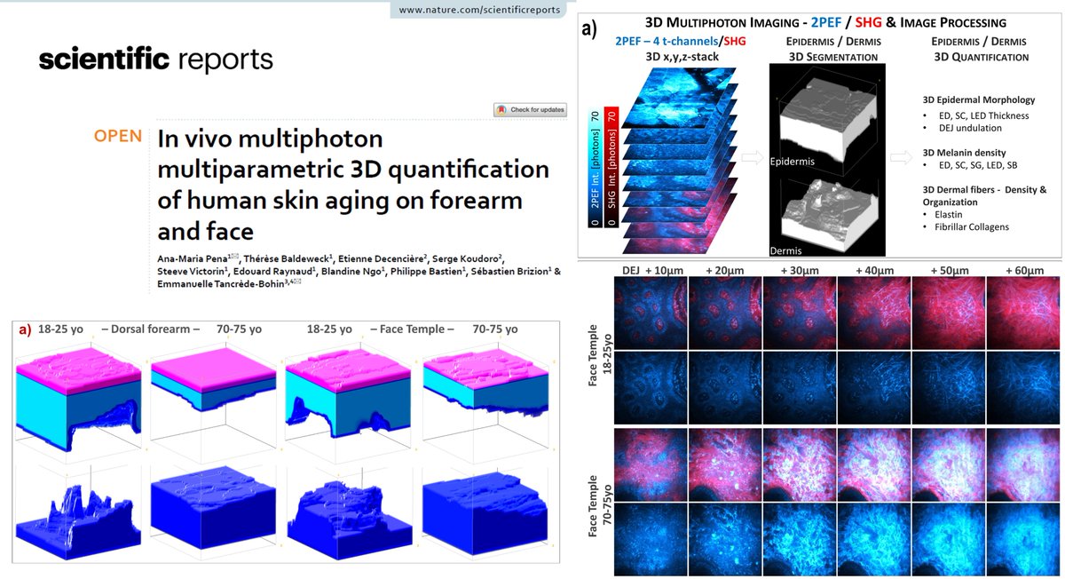 Pena_Ana_Maria's tweet photo. 📰Publication📰In vivo multiphoton multiparametric 3D quantification of human skin aging on forearm and face 👉https://t.co/gTskMguM9S
❗Discover how #InVivo #Multiphoton 🔬 imaging➕ #3DImageProcessing reveal #skinaging changes.
🙏@e_decenciere @Mines_Paris & coll. @LOrealGroupe https://t.co/xmXmVmvz7k