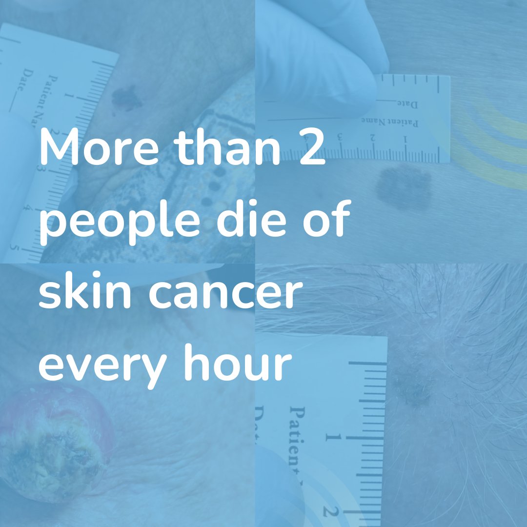 drbenwiese's tweet photo. Facts are scary! Follow sun-safety methods daily to prevent skin cancer!
.
.
.
.
.
.
#skincancer #skincancerscreening #skin #cancer #skincancerawareness #skincancerprevention https://t.co/g7GON0EaLC
