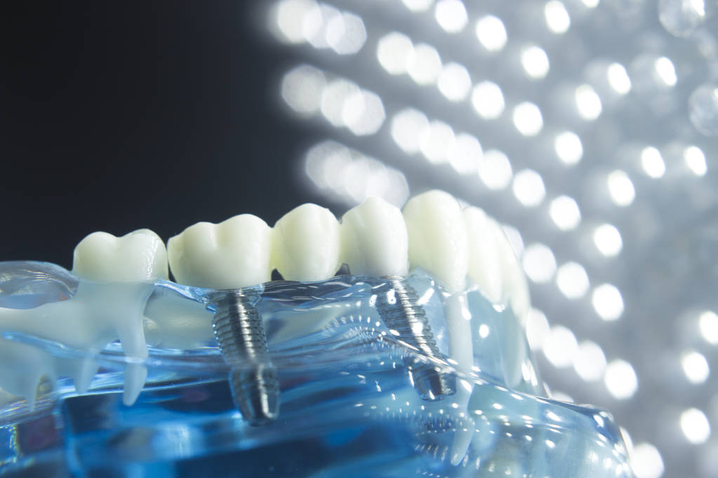 TSM_Trixtank's tweet photo. If you're looking for more information on dental implants cost in Perth, look no further! Perth implant dentists can give you your dream smile at Radiant Smile Dental Care visit now!
https://t.co/UYVHshBXSK
https://t.co/XqA7cRGlkJ
https://t.co/F8KABeSHMb https://t.co/ino0WHw4KY
