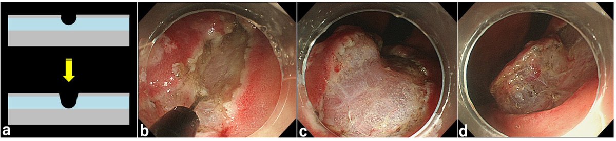MiniSurgery's tweet photo. 🛑Endoscopic submucosal dissection for early gastric adenocarcinoma #ESD
https://t.co/1WDrIDdhR1

🔸basic procedures 
🔹management of complications

👏Dr. Takahiko Nakamura &amp;  Dr. Noriya Uedo

@mkahaleh @RobertBechara @Juangadoctor @neilRsharmaMD @tberzin @ZachSmithGI @sherrywren https://t.co/BotLpB6x55