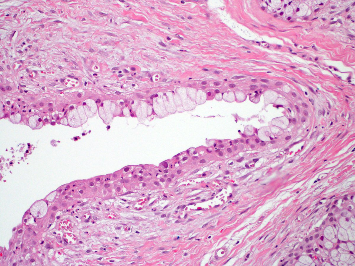 sadiqamer's tweet photo. 34 Years old female with round 1/3 cm hard palate mass
#pathology #pathologist #pathologists @sadiqamer #digitalhealth #histotechnologists #pathart #dermpath @NejibY @JMGardnerMD @Pathologists @IHeartHisto https://t.co/MPspNFKNaR