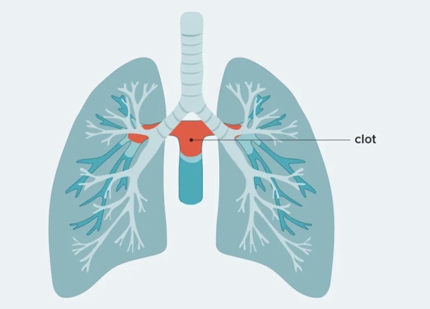 ThrombosisRese1's tweet photo. #review Despite its ominous radiologic appearance, clinical behavior and mortality from #saddle pulmonary embolism are comparable to other pulmonary embolism types. https://t.co/NpLs77f5MT https://t.co/2uZ4jhY32G