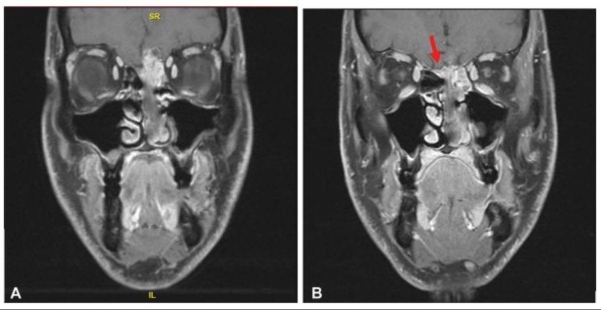 Mayo Clinic ENT (@mayoclinicent) on Twitter photo What are the outcomes associated with esthesioneuroblastoma when compared with other sinonasal malignancies?
Click to read more: bit.ly/3bNJORC
#MayoENTresearch #MayoClinicENT #ENT #HeadAndNeckCancer <a href="/JamieVanGompel/">Jamie Van Gompel MD</a> #GarretChoby #EmilyKarp What are the outcomes associated with esthesioneuroblastoma when compared with other sinonasal malignancies?
Click to read more: bit.ly/3bNJORC
#MayoENTresearch #MayoClinicENT #ENT #HeadAndNeckCancer <a href="/JamieVanGompel/">Jamie Van Gompel MD</a> #GarretChoby #EmilyKarp