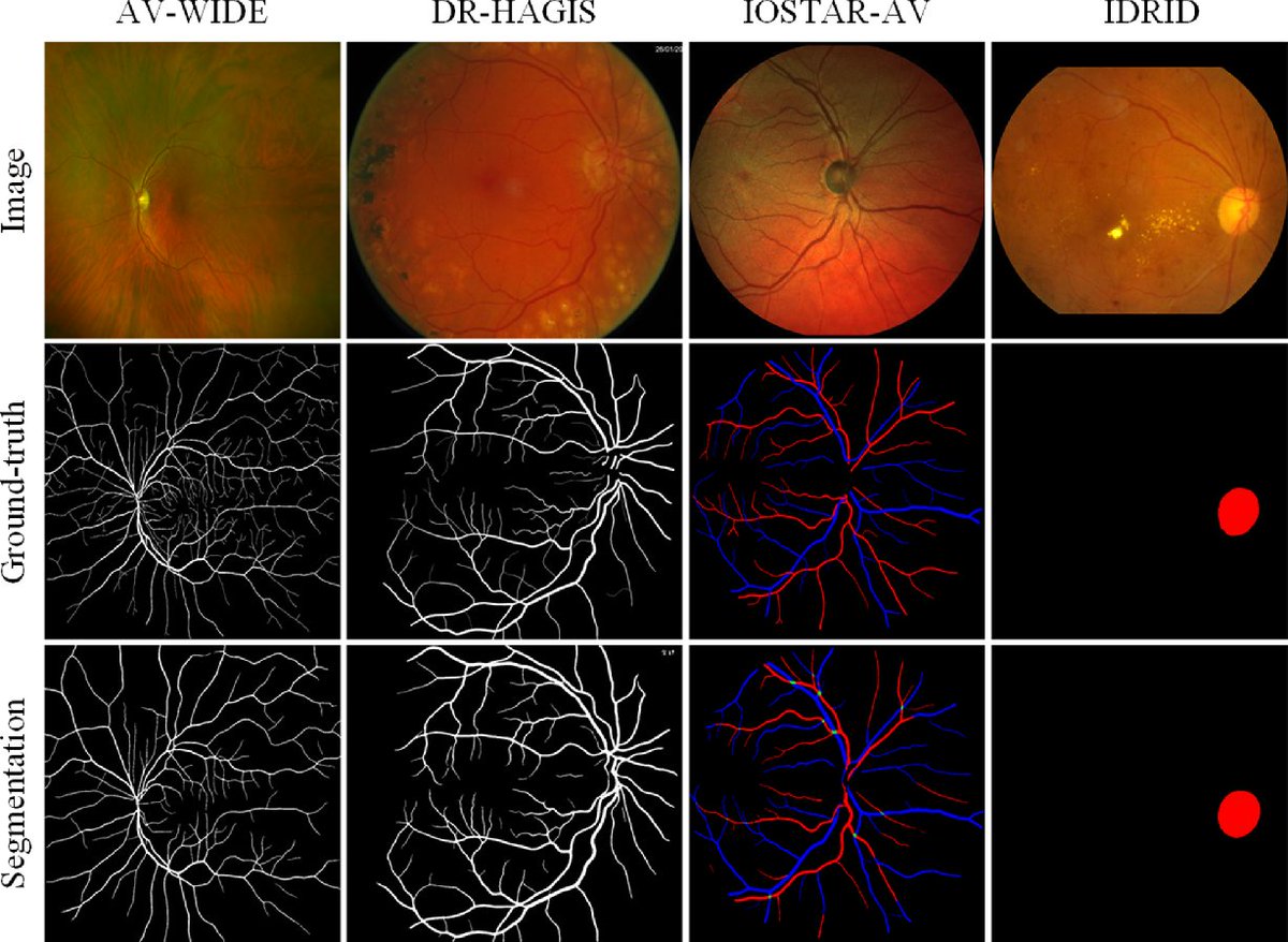 MoorfieldsBRC's tweet photo. AutoMorph is a new tool that analyses retinal photographs, using #AI to measure blood vessels quickly &amp; accurately. Find out how it could help researchers find ways to diagnose a range of health conditions: https://t.co/bcJGnNzG5a 

@Yukunzhou19
@CmicUcl
@Moorfields
@EyeCharity https://t.co/0Iv1zBuUNq