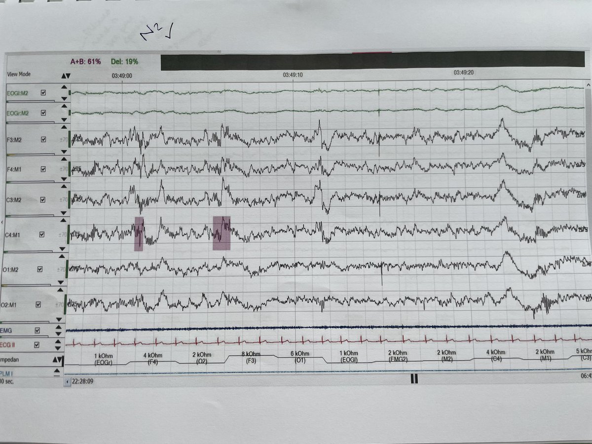 Alice Lester (@aliceblester) on Twitter photo Excellent couple of days at the <a href="/BritishSleepSoc/">BritishSleepSociety</a> #polysomnography (PSG) course. A really interesting course learning how conduct PSG studies, recognise artefacts and score #sleep stages. Looking forward to attending similar courses in the future! Excellent couple of days at the <a href="/BritishSleepSoc/">BritishSleepSociety</a> #polysomnography (PSG) course. A really interesting course learning how conduct PSG studies, recognise artefacts and score #sleep stages. Looking forward to attending similar courses in the future!