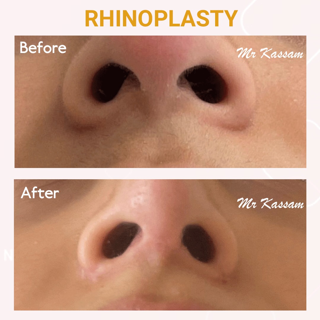 This young patient’s concerns were an over projected nose, nasal hump, poor tip definition and excess nasal flare. 

#mrkarimkassam #plasticsurgery 
#rhinoplasty #beforeafter #results #london #Leicester #LeicesterCity