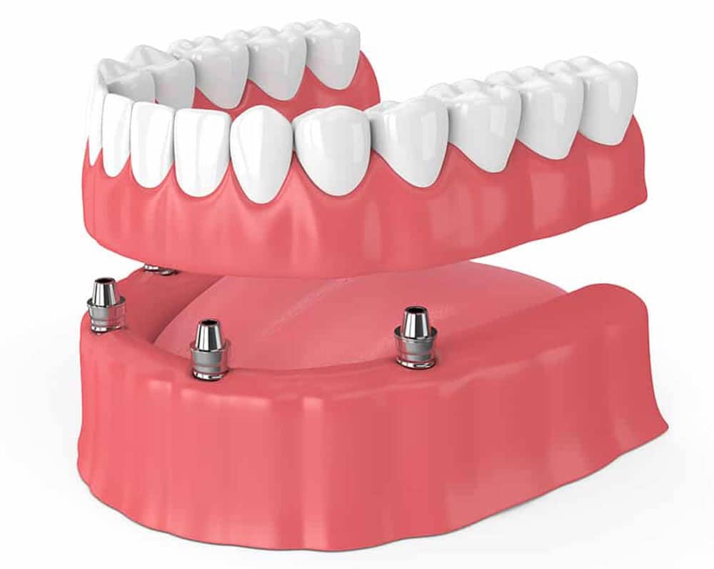 Permanent implant dentures (aka All-on-4s) are an advanced type of denture that are surgically placed in the jaw. They’re more comfortable and stronger than traditional dentures, allowing you to eat and smile with confidence! 💪😃 

📱  Call 503-683-8787