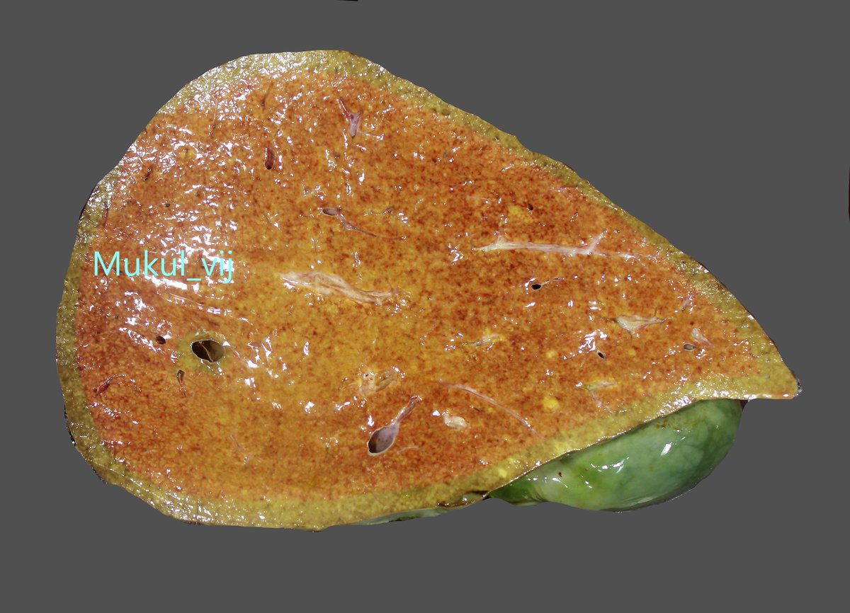 vij_mukul's tweet photo. Acute liver failure (ALF) in an adult
Explant liver
What's ur diagnosis
#pathwtitter #liverpath #livertwitter https://t.co/myCe9kHZJx