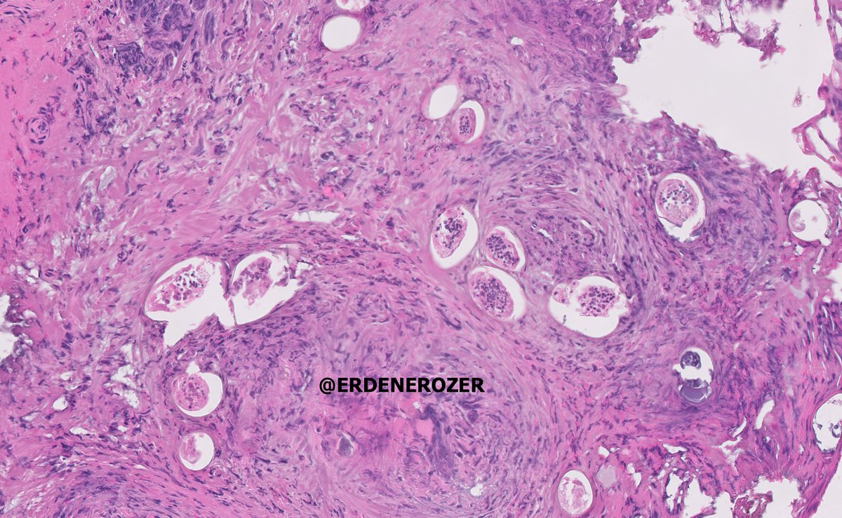 ERDENEROZER's tweet photo. Bladder schistosomiasis in a 6YM.Eggs in the bladder tissue.
-Infection after exposure to cercariae released by snails in fresh water
-Penetration of skin or mucosa
-Migration to bladder plexus and nearby veins or venules 
#PediPath @mreyesm @pembeoltulu @PaedPathSoc @SocPediPath https://t.co/ix3nsYJJQ7