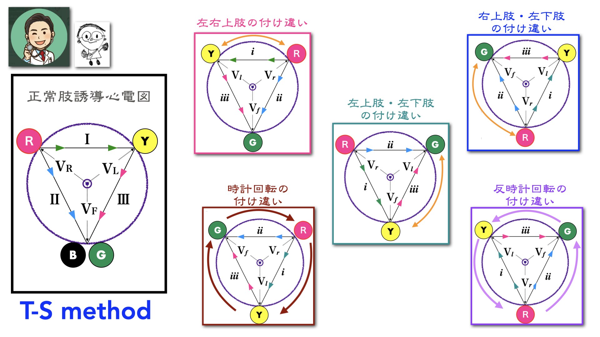 N Tsukishima Ep大学心電図検定学部試験対策科担任 肢誘導の付け違い J 3 2 1 6パターンをお示しします 正常肢誘導 2電極だけ置き換わるパターン３つ 時計回り 反時計回りの全部変わるパターン２つ 覚えるんじゃないんです ３つの おはじき と