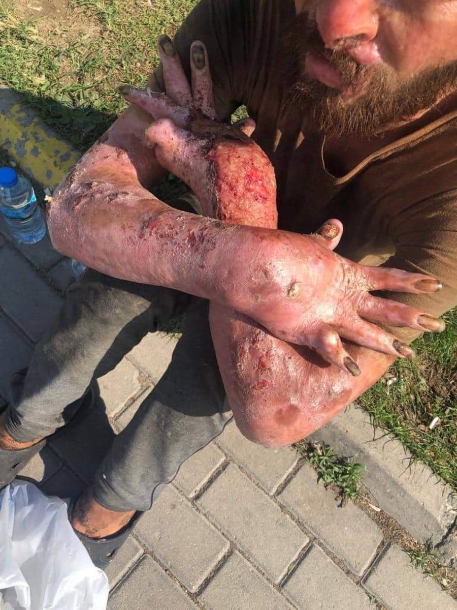 FutsHaberr's tweet photo. Çalışırken geçirdiği tüp kazası sonucu vücudunun her yerini bu şekilde yaralar kaplamış. Kolunu hiçbir şekilde oynatamıyor ihtiyaçlarını gideremiyor. Hastaneye gitmiş Sağlık Bakanlığı sıraya almış ileri bir tarih için ancak bu süre boyunca kimsesi olmadığı için sokakta yaşıyor. https://t.co/AcZMDR3UCD
