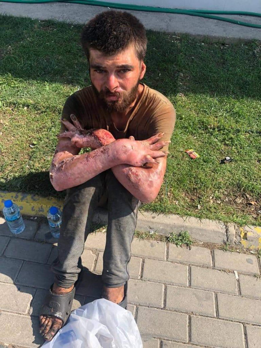 Çalışırken geçirdiği tüp kazası sonucu vücudunun her yerini bu şekilde yaralar kaplamış. Kolunu hiçbir şekilde oynatamıyor ihtiyaçlarını gideremiyor. Hastaneye gitmiş Sağlık Bakanlığı sıraya almış ileri bir tarih için ancak bu süre boyunca kimsesi olmadığı için sokakta yaşıyor.