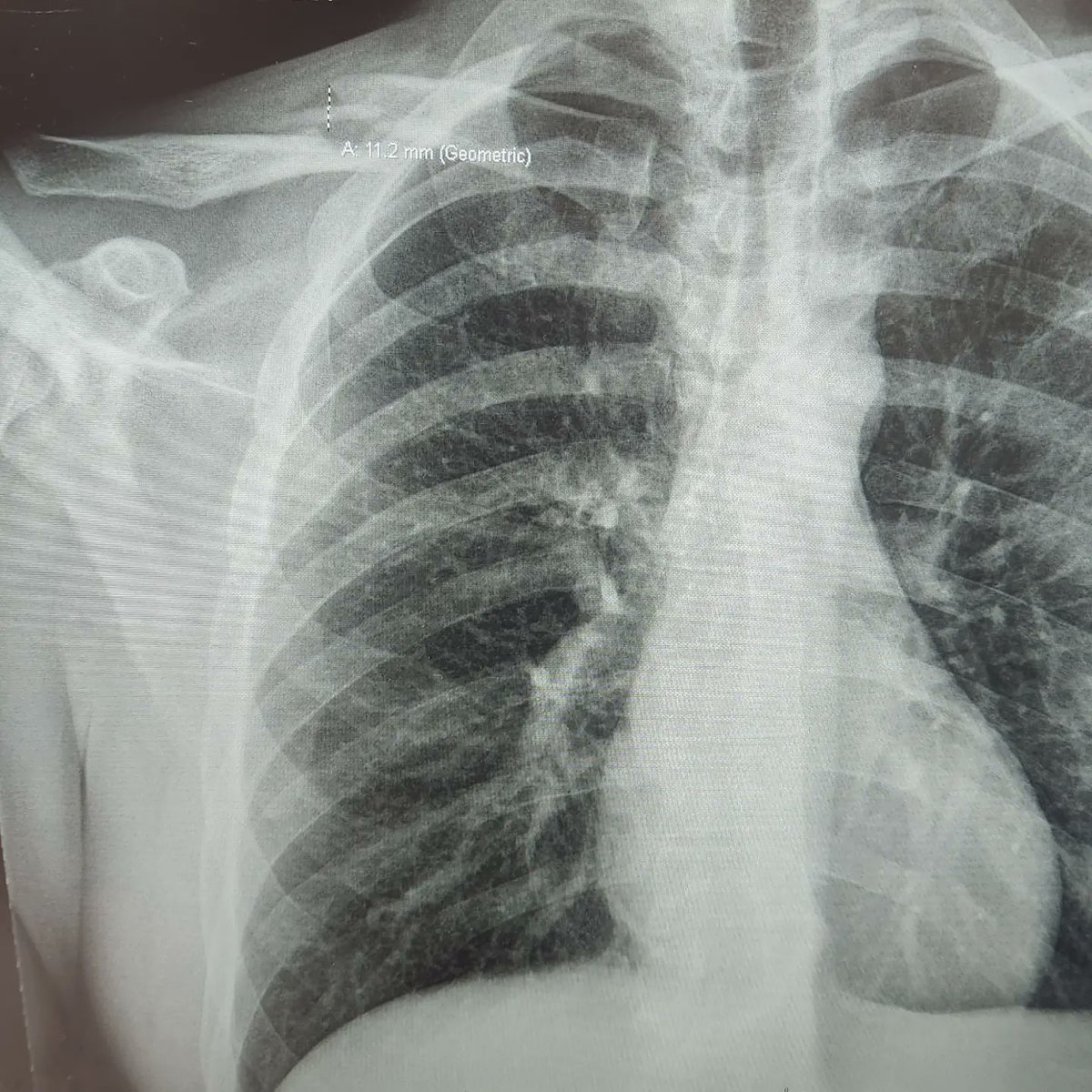 s3thd30's tweet photo. Feel ten feet Friday and broke my collarbone👎 https://t.co/5LH1cTUVya