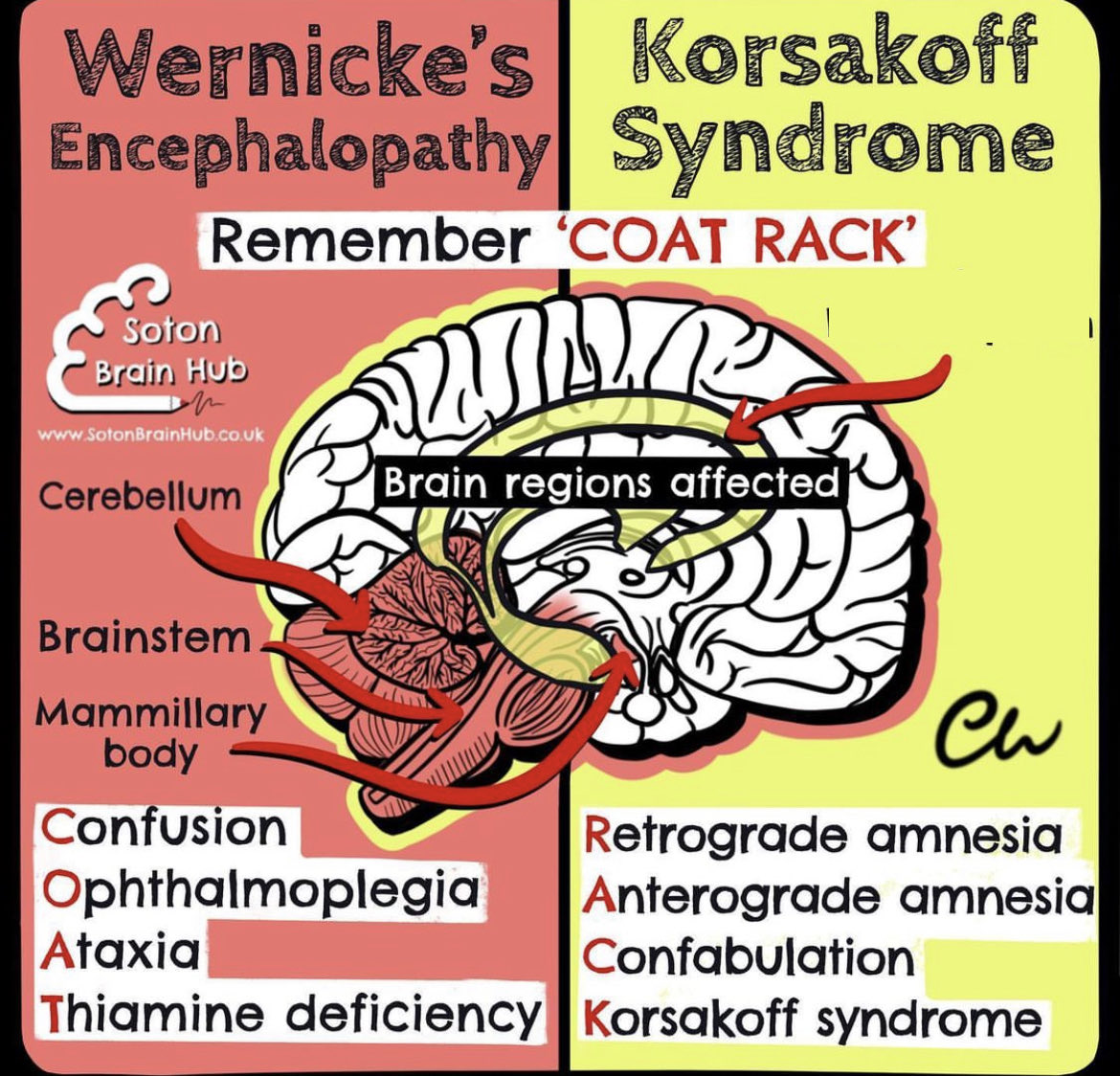 OGdukeneurosurg's tweet photo. Wernicke’s Korsakoff primer  by Soton.  Remember to check for confabulation. https://t.co/7Ig5beZQHe