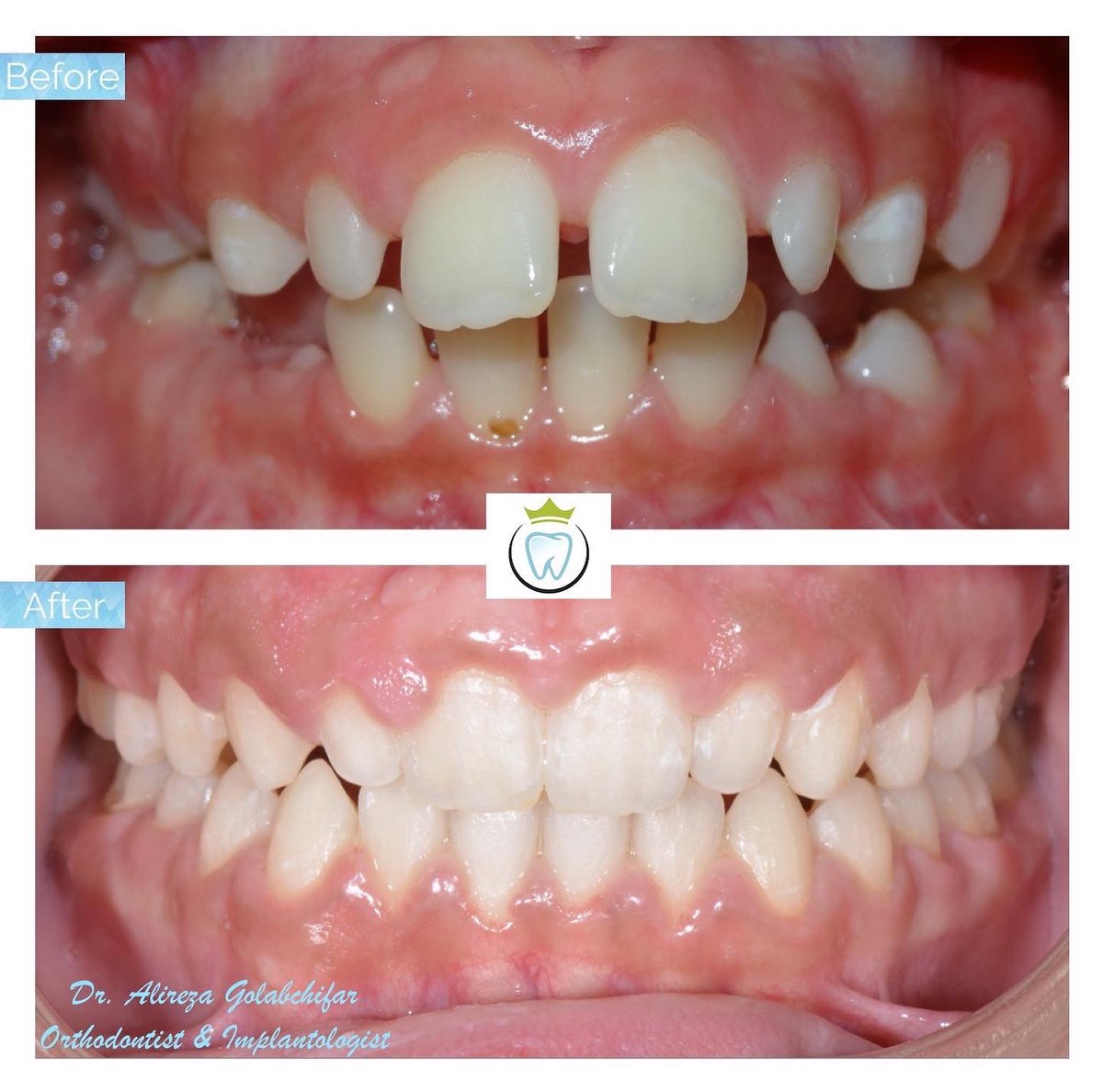 dentistry_king's tweet photo. We utilized growth modification appliances and braces to achieve this fantastic result! 

#orthodontics #braces #smile #smiletransformation #cosmeticdentistry #orthosmile #orthosmiletoronto #dentistry #empresswalkdental #kingwestdentistry #torontodentalclinic https://t.co/WXbSjl1y3l