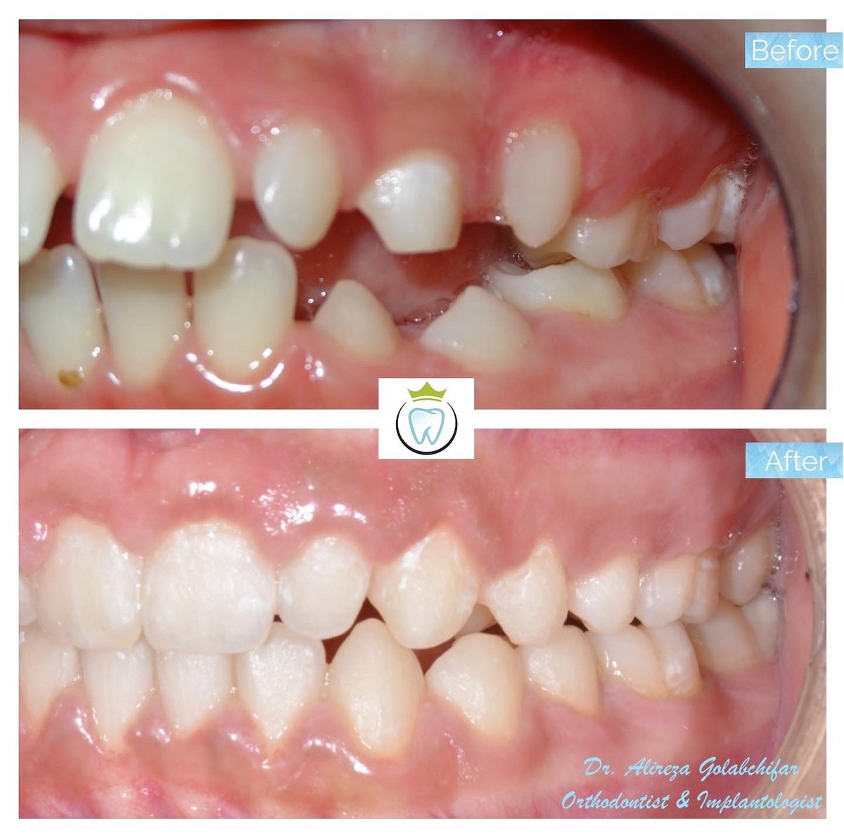 dentistry_king's tweet photo. We utilized growth modification appliances and braces to achieve this fantastic result! 

#orthodontics #braces #smile #smiletransformation #cosmeticdentistry #orthosmile #orthosmiletoronto #dentistry #empresswalkdental #kingwestdentistry #torontodentalclinic https://t.co/WXbSjl1y3l