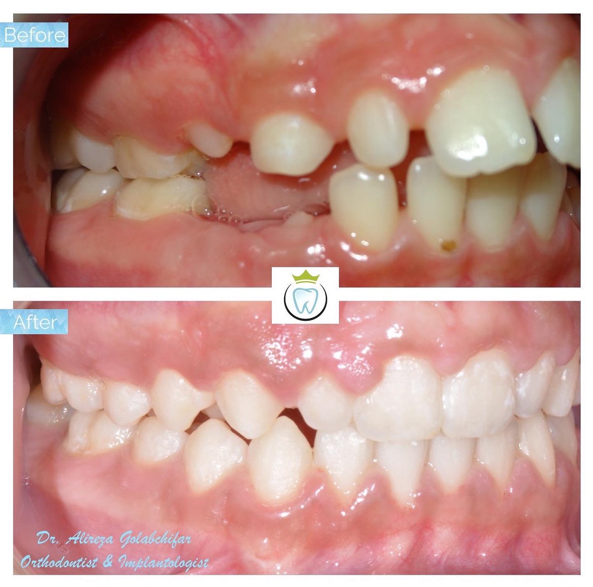 dentistry_king's tweet photo. We utilized growth modification appliances and braces to achieve this fantastic result! 

#orthodontics #braces #smile #smiletransformation #cosmeticdentistry #orthosmile #orthosmiletoronto #dentistry #empresswalkdental #kingwestdentistry #torontodentalclinic https://t.co/WXbSjl1y3l