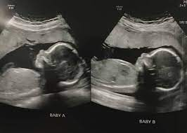 TitanessSam's tweet photo. I, or Joseph, will most definitely keep you all posted. We're all super excited and ready for Alexander and Cersei's arrival. ❤️

3/3

#31WeeksPregnant 
#PregnantWithTwins 
#FutureTitans 
#FutureBerserkers
#PregnancyUpdate
#PregnancyGlow https://t.co/rckgvJcS55