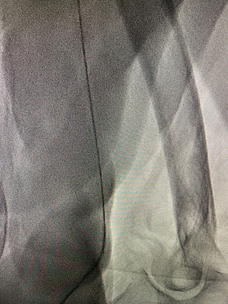 Some suprises during the last #coronaryangiography of the day 😅 Succesfully handled 🧿
#cardiotwitter