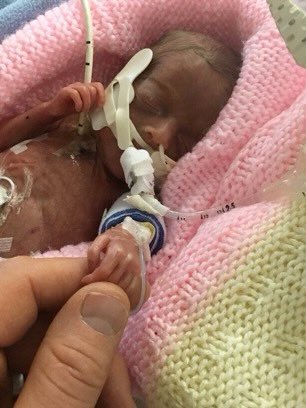 bgrange33's tweet photo. How it started, how it’s going😍🥰👍👍👍 @NeonatalBTHFT @Leeds_Childrens https://t.co/WuxMr59vhH