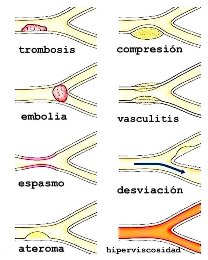 Diversos procesos patológicos que pueden ocurrir en los vasos sanguíneos 😷