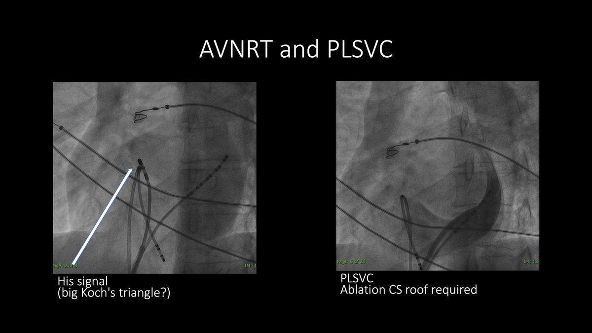 FellowEP's tweet photo. 39y💁🏻♀️#Redo #AVNRT ablation. At 1st look Koch’s triangle enlarged and dilated CS. Venogram to define anatomy showed #LPSVC. Tough ablation indeed that required CS roof ablation to finally eliminate slow pathway conduction #eppeps @victorneirav @HHHATEMUCO @LAHRSonline1 https://t.co/2dZJje9xDJ